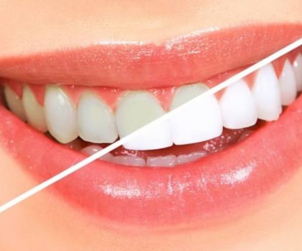 दांतोंं से टार्टर और प्लाक हटाने के कारगर घरेलू उपाय